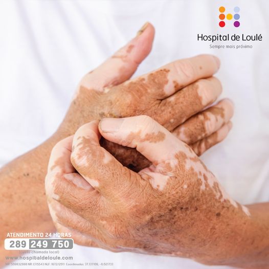 O que é o vitiligo?