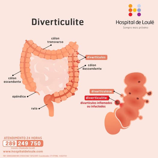 How to control diverticulitis through diet?