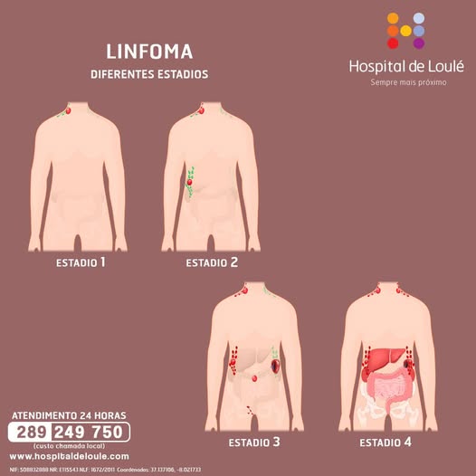 Linfoma